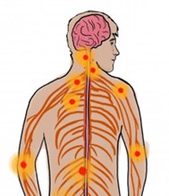 Ein Rücken und Kopf sind abgebildet. Das Gehirn ist eingezeichnet genauso wie die Nervenfasern im Rücken. Dort sind viele Schmerzpunkte rot eingezeichnet.